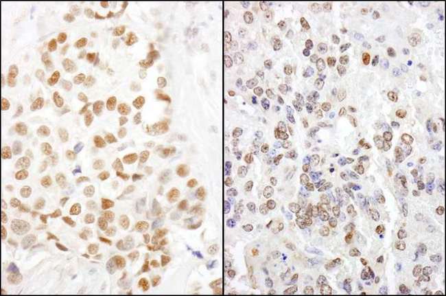 HMGN1 / HMG14 Antibody - Detection of Human and Mouse HMGN1 by Immunohistochemistry. Sample: FFPE section of human breast carcinoma (left) and mouse teratoma (right). Antibody: Affinity purified rabbit anti-HMGN1 used at a dilution of 1:5000 (0.2 Detection: DAB.