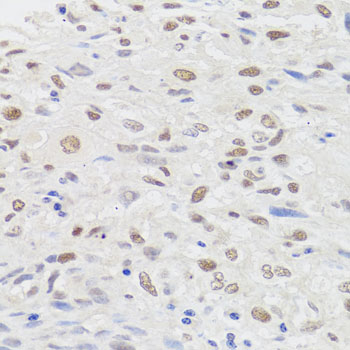 HMGN1 / HMG14 Antibody - Immunohistochemistry of paraffin-embedded human lung cancer tissue.