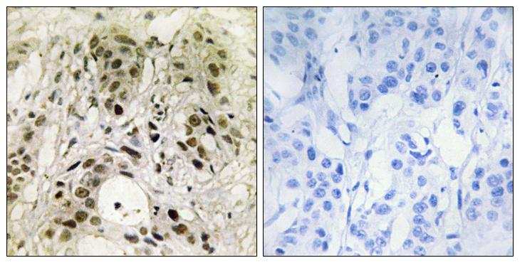 HMGN1 / HMG14 Antibody - Peptide - + Immunohistochemistry analysis of paraffin-embedded human breast carcinoma tissue using HMG14 antibody.