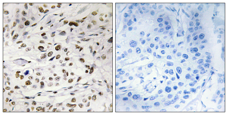 HMGN1 / HMG14 Antibody - Immunohistochemistry analysis of paraffin-embedded human breast carcinoma, using HMG14 (Phospho-Ser21) Antibody. The picture on the right is blocked with the phospho peptide.