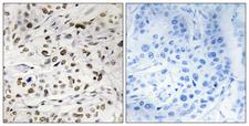 HMGN1 / HMG14 Antibody - P-peptide - + Immunohistochemistry analysis of paraffin-embedded human breast carcinoma tissue using HMG14 (Phospho-Ser21) antibody.