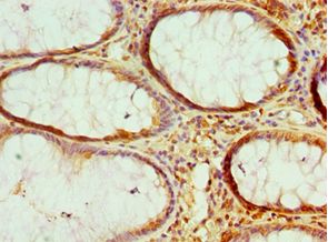 HMGN2 Antibody - Immunohistochemistry of paraffin-embedded human colon cancer using antibody at 1:100 dilution.