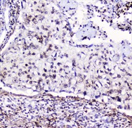 HMGN2 Antibody - IHC analysis of HMGN2 using anti-HMGN2 antibody. HMGN2 was detected in paraffin-embedded section of human lung cancer tissue. Heat mediated antigen retrieval was performed in citrate buffer (pH6, epitope retrieval solution) for 20 mins. The tissue section was blocked with 10% goat serum. The tissue section was then incubated with 2µg/ml rabbit anti-HMGN2 Antibody overnight at 4°C. Biotinylated goat anti-rabbit IgG was used as secondary antibody and incubated for 30 minutes at 37°C. The tissue section was developed using Strepavidin-Biotin-Complex (SABC) with DAB as the chromogen.