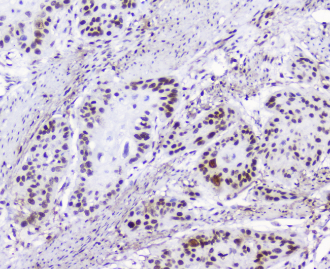 HMGN2 Antibody - IHC analysis of HMGN2 using anti-HMGN2 antibody. HMGN2 was detected in paraffin-embedded section of human oesophagus squama cancer tissue. Heat mediated antigen retrieval was performed in citrate buffer (pH6, epitope retrieval solution) for 20 mins. The tissue section was blocked with 10% goat serum. The tissue section was then incubated with 2µg/ml rabbit anti-HMGN2 Antibody overnight at 4°C. Biotinylated goat anti-rabbit IgG was used as secondary antibody and incubated for 30 minutes at 37°C. The tissue section was developed using Strepavidin-Biotin-Complex (SABC) with DAB as the chromogen.