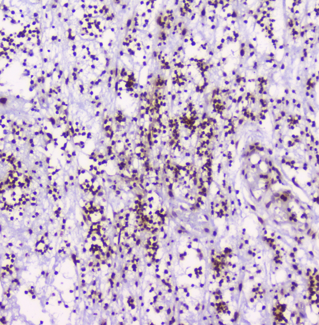 HMGN2 Antibody - IHC analysis of HMGN2 using anti-HMGN2 antibody. HMGN2 was detected in paraffin-embedded section of human appendicitis tissue. Heat mediated antigen retrieval was performed in citrate buffer (pH6, epitope retrieval solution) for 20 mins. The tissue section was blocked with 10% goat serum. The tissue section was then incubated with 2µg/ml rabbit anti-HMGN2 Antibody overnight at 4°C. Biotinylated goat anti-rabbit IgG was used as secondary antibody and incubated for 30 minutes at 37°C. The tissue section was developed using Strepavidin-Biotin-Complex (SABC) with DAB as the chromogen.