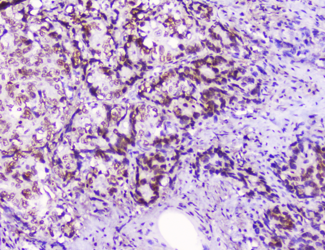 HMGN2 Antibody - IHC analysis of HMGN2 using anti-HMGN2 antibody. HMGN2 was detected in paraffin-embedded section of human gastric cancer tissue. Heat mediated antigen retrieval was performed in citrate buffer (pH6, epitope retrieval solution) for 20 mins. The tissue section was blocked with 10% goat serum. The tissue section was then incubated with 2µg/ml rabbit anti-HMGN2 Antibody overnight at 4°C. Biotinylated goat anti-rabbit IgG was used as secondary antibody and incubated for 30 minutes at 37°C. The tissue section was developed using Strepavidin-Biotin-Complex (SABC) with DAB as the chromogen.