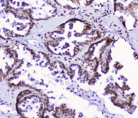 HMGN2 Antibody - IHC analysis of HMGN2 using anti-HMGN2 antibody. HMGN2 was detected in paraffin-embedded section of human ovary cancer tissue. Heat mediated antigen retrieval was performed in citrate buffer (pH6, epitope retrieval solution) for 20 mins. The tissue section was blocked with 10% goat serum. The tissue section was then incubated with 2µg/ml rabbit anti-HMGN2 Antibody overnight at 4°C. Biotinylated goat anti-rabbit IgG was used as secondary antibody and incubated for 30 minutes at 37°C. The tissue section was developed using Strepavidin-Biotin-Complex (SABC) with DAB as the chromogen.
