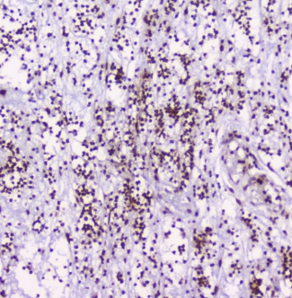 HMGN2 Antibody - IHC staining of FFPE human appendicitis with HMGN2 antibody at 2ug/ml. HIER: boil tissue sections in pH6, 10mM citrate buffer, for 10-20 min followed by cooling at RT for 20 min.