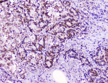 HMGN2 Antibody - IHC staining of FFPE human stomach cancer with HMGN2 antibody at 2ug/ml. HIER: boil tissue sections in pH6, 10mM citrate buffer, for 10-20 min followed by cooling at RT for 20 min.