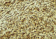 HMGN2 Antibody - 1:100 staining human breast carcinoma tissue by IHC-P. The sample was formaldehyde fixed and a heat mediated antigen retrieval step in citrate buffer was performed. The sample was then blocked and incubated with the antibody for 1.5 hours at 22°C. An HRP conjugated goat anti-rabbit antibody was used as the secondary.