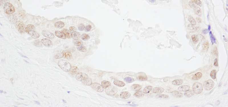 HMGN3 Antibody - Detection of Human HMGN3 by Immunohistochemistry. Sample: FFPE section of human prostate carcinoma. Antibody: Affinity purified rabbit anti-HMGN3 used at a dilution of 1:1000 (1 Detection: DAB.