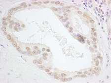 HMGN3 Antibody - Detection of Human HMGN3 by Immunohistochemistry. Sample: FFPE section of human prostate carcinoma. Antibody: Affinity purified rabbit anti-HMGN3 used at a dilution of 1:1000 (0.2 Detection: DAB.