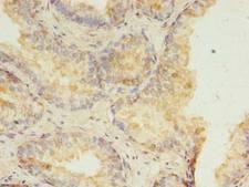 HMGN3 Antibody - Immunohistochemistry of paraffin-embedded human prostate cancer using antibody at 1:100 dilution.