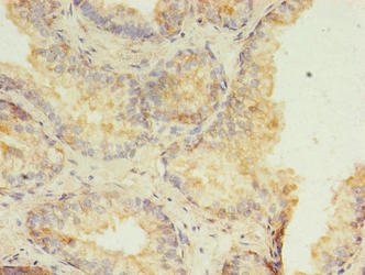 HMGN3 Antibody - Immunohistochemistry of paraffin-embedded human prostate cancer using HMGN3 Antibody at dilution of 1:100