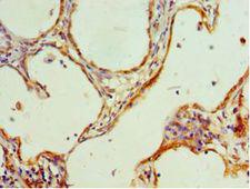 HMGN4 Antibody - Immunohistochemistry of paraffin-embedded human cervical cancer using antibody at 1:100 dilution.