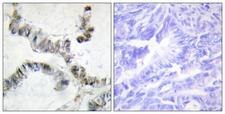 HMGXB3 / SMF Antibody - Peptide - + Immunohistochemistry analysis of paraffin-embedded human colon carcinoma tissue, using SMF antibody.