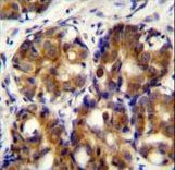 HMMR / CD168 / RHAMM Antibody - HMMR Antibody immunohistochemistry of formalin-fixed and paraffin-embedded human breast carcinoma followed by peroxidase-conjugated secondary antibody and DAB staining.