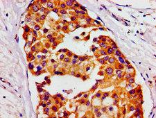 HMMR / CD168 / RHAMM Antibody - Immunohistochemistry image of paraffin-embedded human breast cancer at a dilution of 1:100