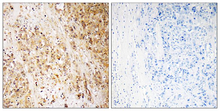 HMMR / CD168 / RHAMM Antibody - Peptide - + Immunohistochemistry analysis of paraffin-embedded human breast carcinoma tissue, using HMMR antibody.