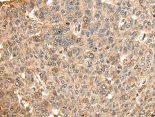 HMMR / CD168 / RHAMM Antibody - Immunohistochemistry of paraffin-embedded Human liver cancer tissue  using HMMR Polyclonal Antibody at dilution of 1:45(×200)