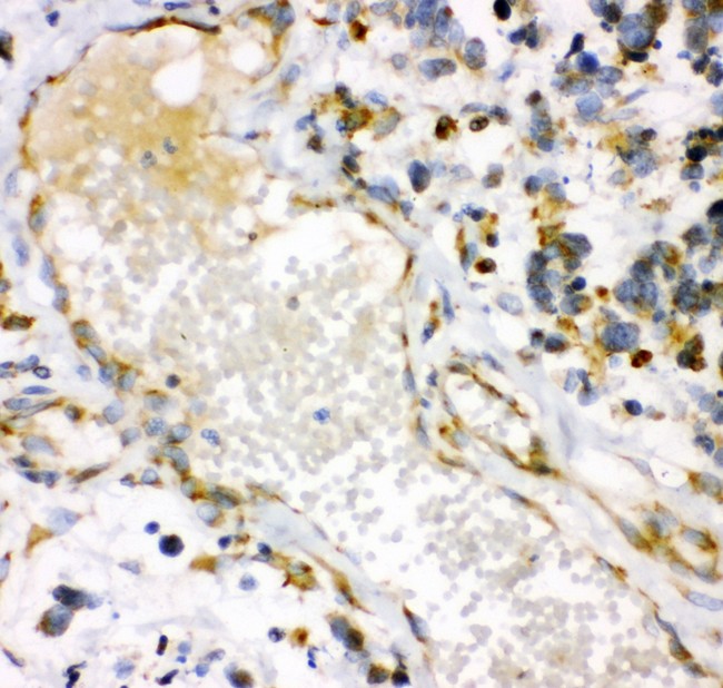 HMOX1 / HO-1 Antibody - HMOX1 antibody IHC-paraffin: Human Lung Cancer Tissue.