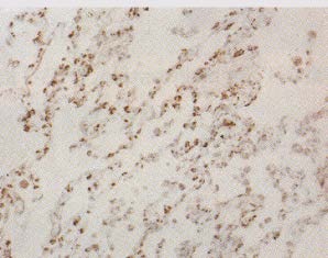 HMOX1 / HO-1 Antibody - Detection of HO-1 in human lung carcinoma.