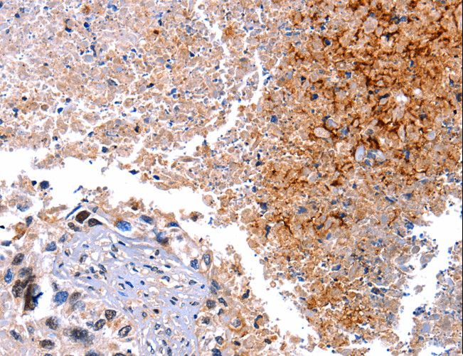 HMOX1 / HO-1 Antibody - Immunohistochemistry of paraffin-embedded Human lung cancer using HMOX1 Polyclonal Antibody at dilution of 1:40.