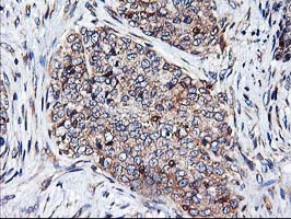 HMOX2 / Heme Oxygenase 2 Antibody - IHC of paraffin-embedded Adenocarcinoma of Human breast tissue using anti-HMOX2 mouse monoclonal antibody.
