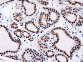 HMOX2 / Heme Oxygenase 2 Antibody - IHC of paraffin-embedded Carcinoma of Human thyroid tissue using anti-HMOX2 mouse monoclonal antibody.