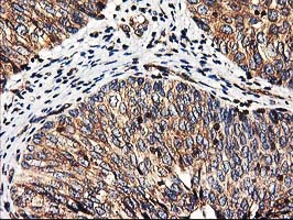 HMOX2 / Heme Oxygenase 2 Antibody - IHC of paraffin-embedded Carcinoma of Human bladder tissue using anti-HMOX2 mouse monoclonal antibody.