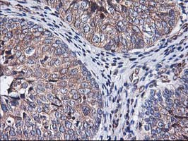 HMOX2 / Heme Oxygenase 2 Antibody - IHC of paraffin-embedded Carcinoma of Human bladder tissue using anti-HMOX2 mouse monoclonal antibody.