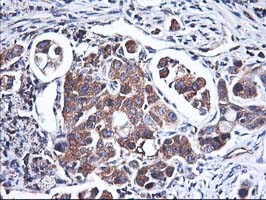 HMOX2 / Heme Oxygenase 2 Antibody - IHC of paraffin-embedded Carcinoma of Human lung tissue using anti-HMOX2 mouse monoclonal antibody.