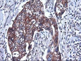 HMOX2 / Heme Oxygenase 2 Antibody - IHC of paraffin-embedded Carcinoma of Human pancreas tissue using anti-HMOX2 mouse monoclonal antibody.