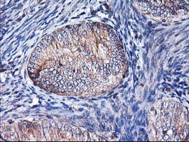 HMOX2 / Heme Oxygenase 2 Antibody - IHC of paraffin-embedded Adenocarcinoma of Human endometrium tissue using anti-HMOX2 mouse monoclonal antibody.