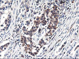 HMOX2 / Heme Oxygenase 2 Antibody - IHC of paraffin-embedded Carcinoma of Human lung tissue using anti-HMOX2 mouse monoclonal antibody.
