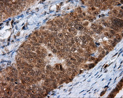 HMRF1L / MTRF1L Antibody - IHC of paraffin-embedded Adenocarcinoma of ovary tissue using anti-MTRF1L mouse monoclonal antibody. (Dilution 1:50).