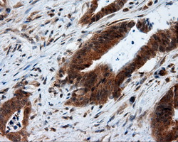 HMRF1L / MTRF1L Antibody - IHC of paraffin-embedded Adenocarcinoma of colon tissue using anti-MTRF1L mouse monoclonal antibody. (Dilution 1:50).