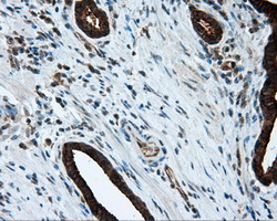 HMRF1L / MTRF1L Antibody - IHC of paraffin-embedded Carcinoma of prostate tissue using anti-MTRF1L mouse monoclonal antibody. (Dilution 1:50).