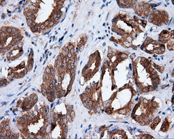 HMRF1L / MTRF1L Antibody - Immunohistochemical staining of paraffin-embedded Carcinoma of prostate tissue using anti-MTRF1L mouse monoclonal antibody. (Dilution 1:50).