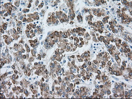 HMRF1L / MTRF1L Antibody - Immunohistochemical staining of paraffin-embedded Carcinoma of Human liver tissue using anti-MTRF1L mouse monoclonal antibody. (Dilution 1:50).