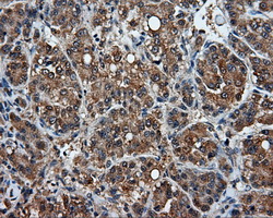 HMRF1L / MTRF1L Antibody - Immunohistochemical staining of paraffin-embedded Carcinoma of liver tissue using anti-MTRF1L mouse monoclonal antibody. (Dilution 1:50).