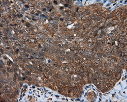 HMRF1L / MTRF1L Antibody - Immunohistochemical staining of paraffin-embedded Adenocarcinoma of ovary tissue using anti-MTRF1L mouse monoclonal antibody. (Dilution 1:50).