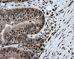 HMRF1L / MTRF1L Antibody - Immunohistochemical staining of paraffin-embedded Adenocarcinoma of colon tissue using anti-MTRF1L mouse monoclonal antibody. (Dilution 1:50).