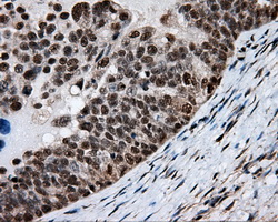 HMRF1L / MTRF1L Antibody - Immunohistochemical staining of paraffin-embedded Adenocarcinoma of ovary tissue using anti-MTRF1L mouse monoclonal antibody. (Dilution 1:50).