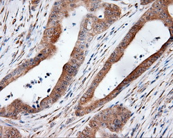 HMRF1L / MTRF1L Antibody - Immunohistochemical staining of paraffin-embedded Adenocarcinoma of colon tissue using anti-MTRF1L mouse monoclonal antibody. (Dilution 1:50).