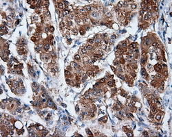 HMRF1L / MTRF1L Antibody - Immunohistochemical staining of paraffin-embedded Carcinoma of liver tissue using anti-MTRF1L mouse monoclonal antibody. (Dilution 1:50).