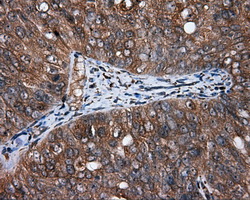 HMRF1L / MTRF1L Antibody - Immunohistochemical staining of paraffin-embedded Adenocarcinoma of ovary tissue using anti-MTRF1L mouse monoclonal antibody. (Dilution 1:50).