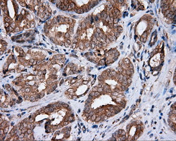 HMRF1L / MTRF1L Antibody - Immunohistochemical staining of paraffin-embedded Carcinoma of prostate tissue using anti-MTRF1L mouse monoclonal antibody. (Dilution 1:50).