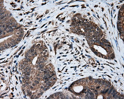 HMRF1L / MTRF1L Antibody - IHC of paraffin-embedded Adenocarcinoma of colon tissue using anti-MTRF1L mouse monoclonal antibody. (Dilution 1:50).