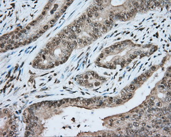 HMRF1L / MTRF1L Antibody - Immunohistochemical staining of paraffin-embedded Adenocarcinoma of Human colon tissue using anti-MTRF1L mouse monoclonal antibody. (Dilution 1:50).